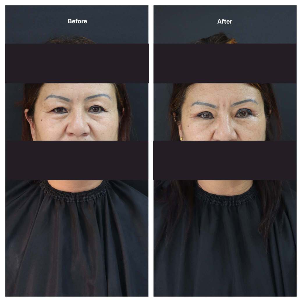 Eyelid Surgery KOQ10